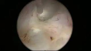 Real-life ThuLEP case number 4: 10-minute enucleation of a small gland