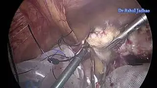 Huge ovarian dermoid removal by laparoscopy using urine collection bag as endobag