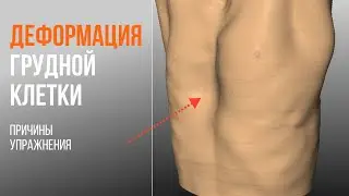 Деформация грудной клетки. Упражнения