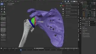 Reverse total shoulder replacement - surgical planning and animation - OrthoMesh3D in Blender