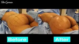 Mother of 4 gets BBL and looks AMAZING!!!