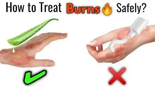 How to Treat Burn at Home? || Types of Burns