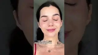 ✅ результат #ринопластика #пластическаяоперация #globalmedik #ринопластикатурция