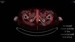PSMA PET/CT F-18 Pylarify Case 5