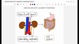 MEDIAN ARCUATE LIGAMENT SYNDROME