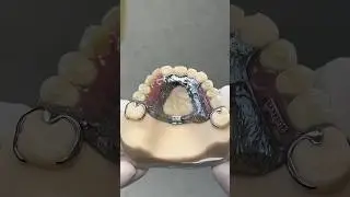 Upper Titanium Partial @EnvisiontecMain #envisiontec #lsk121shorts #dental #teeth