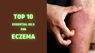 Top 10 Essential Oils For Eczema | Health Tips | Sky world