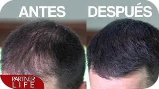 Probando el TOPPIK | Trasplante de pelo
