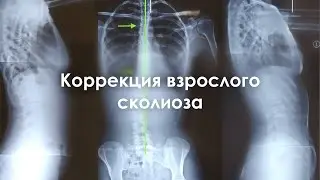 Почему у взрослого невозможно исправить снимок при сколиозе?