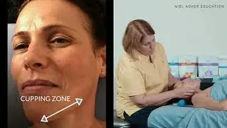 Massage Cupping - Facial Rejuvenation