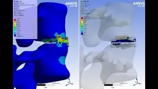 FEA of Cervical Disc Replacement with Prestige LP Disc from Medtronic - ANSYS WB Static Structural