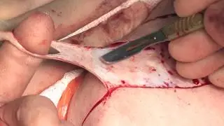 Inferior Pedicle Therapeutic Mammoplasty