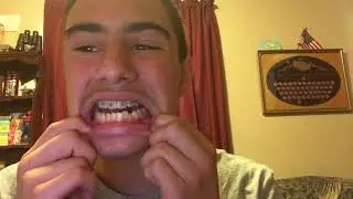 I got my bottom braces! (Before and after)