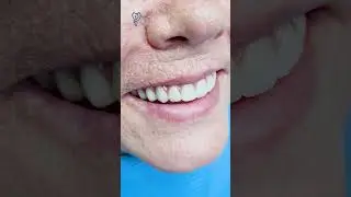 Another All-on-6 beauty for a completely edentulous jaw. Dental implants.