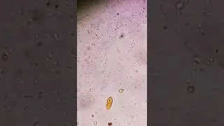 Yeast cells and Bacteria seen on stool analysis 