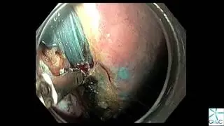ESD Resection of a superficial gastric cancer
