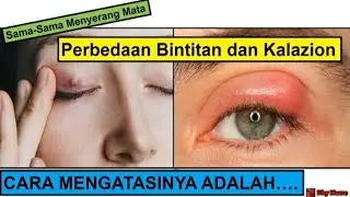 BINTITAN ATAU KALAZION ? Ini Perbedaan dan Cara Mengatasinya