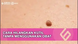 Ampuh! Cara Hilangkan Kutil Dengan Bawang Putih Agar Tak Tumbuh Lagi