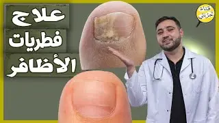 2 دواء رخيص لعلاج فطريات الأظافر نهائيا متوفر فى الصيدلية عن تجربة