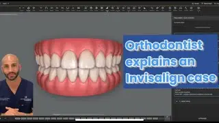 Orthodontist who treated himself w/ Invisalign reviews an Invisalign case that relapsed after braces