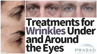 How to Treat Wrinkles Under and Around the Eyes