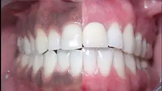 How to get rid of #DARK GUMS? causes & treatment for #blackgums