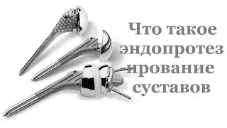 Что такое эндопротезирование суставов