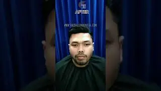 Solusi kebotakan pria dalam 2 jam