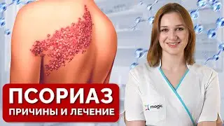 Забудь о ШЕЛУШЕНИИ КОЖИ! / Что такое ПСОРИАЗ и как его ЛЕЧИТЬ?