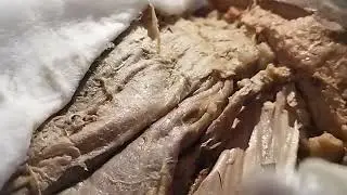 Inguinal canal-Dissection in Female. by. Dr. Veeramalla.