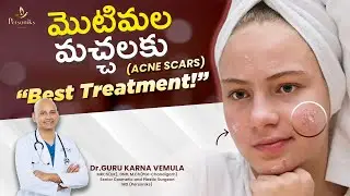 మొటిమల మచ్చలకు ( Acne Scars ) Best Treatment | Dr. Guru Karna | Personiks |
