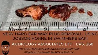 12 DAYS OF WAXMAS - EAR WAX REMOVAL DAY 2 - EP 268