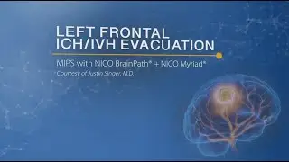 Left Frontal ICH/IVH Evacuation, Justin Singer MD