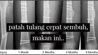 makanan yang bagus untuk penyembuhan patah tulang