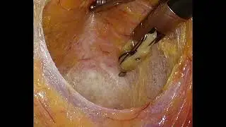 Laparoscopic TME for a rectal NET with the multiarticular electric scalpel, ArtiSential®