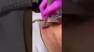 Como tratar flacidez de pescoço e colo?