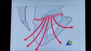 Acetabular fractures