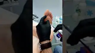 Анестезия бородавки в клинике "Асклепион"