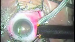 Macular Hole Surgery | MIVS Surgery | Dr Madhusudan Davda | Mumbai Eye Retina Clinic