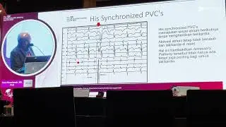 Differentiating challenging SVT from EGM/EP study