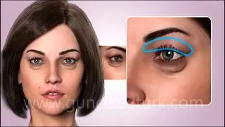 ¿Cómo se realiza las operaciónes de estética de los parpados inferior y exterior (blefaroplastia)?
