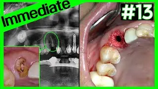 [Online Surgery] #13 immediate implant placement (KSⅢ) with dual zone graft