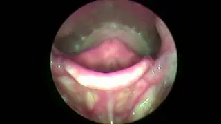 Laringitis Infecciosa