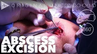 Recurrent Breast Abscess Excision - Dr. Junko Ozao-Choy | Preview