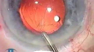 Descemets Peel Phaco 3.1 Complications