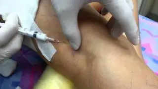 Лечение сосудистых звездочек на ногах