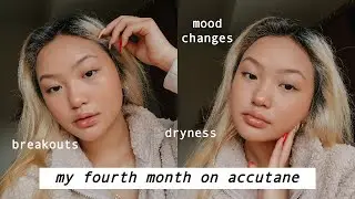 my accutane journey month 4