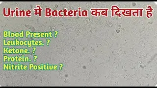 Bacterial count in urine | bacterial urine infection | bacteria in urine report | nitrite Positive