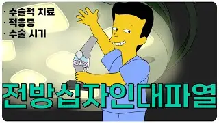 전방십자인대파열 시즌2-10 : 수술적치료, 적응증, 시기