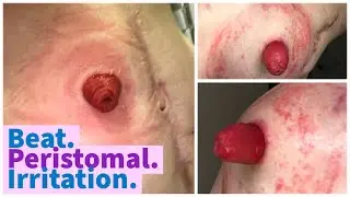 How to Beat Peristomal Irritation + Tutorial